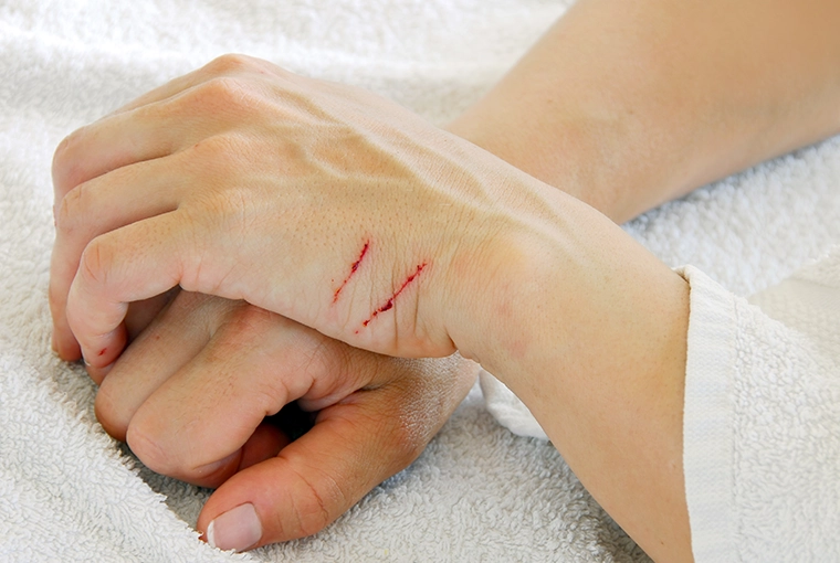 Close-up of cat scratches on fair, adult woman's side of hands.